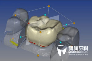 種植牙3D打印 幾天種好牙將成可能